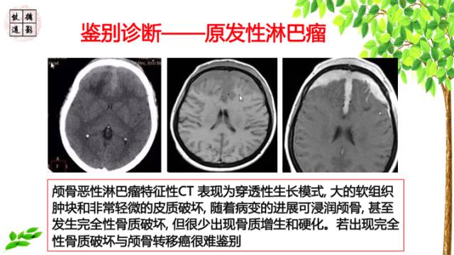 【病例】颞骨骨巨细胞瘤1例CT及MR影像诊断分析