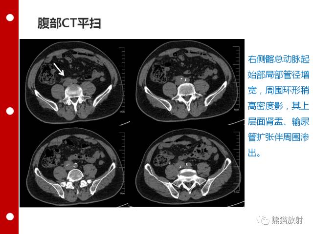 【病例】误诊为壁间血肿的腹膜后纤维化1例CT/PET影像表现