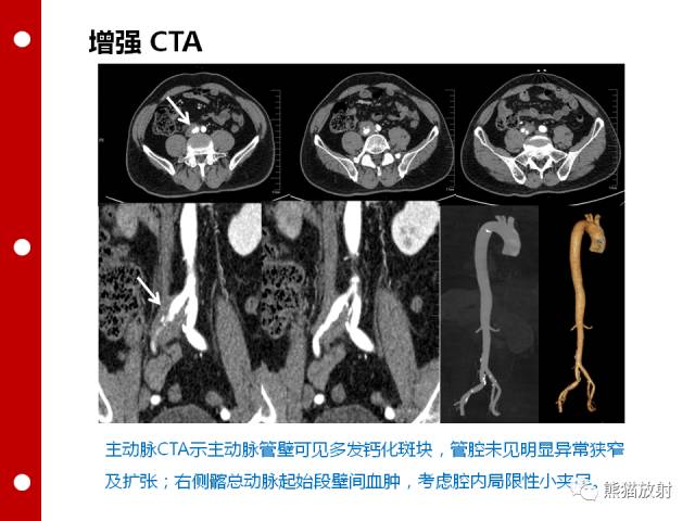 【病例】误诊为壁间血肿的腹膜后纤维化1例CT/PET影像表现
