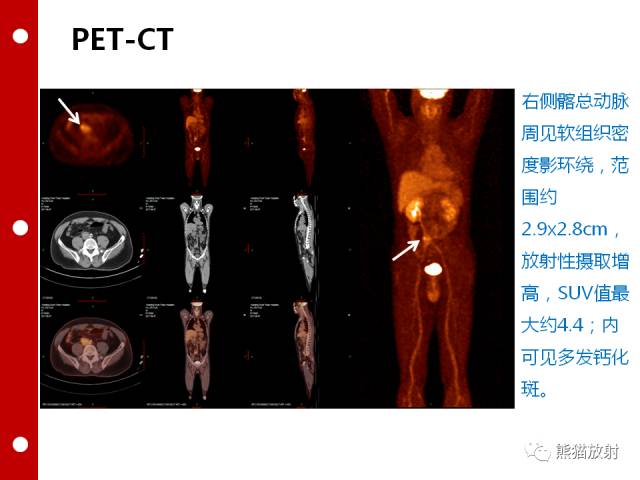【病例】误诊为壁间血肿的腹膜后纤维化1例CT/PET影像表现