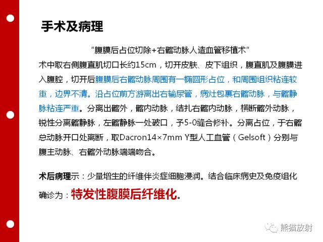 【病例】误诊为壁间血肿的腹膜后纤维化1例CT/PET影像表现