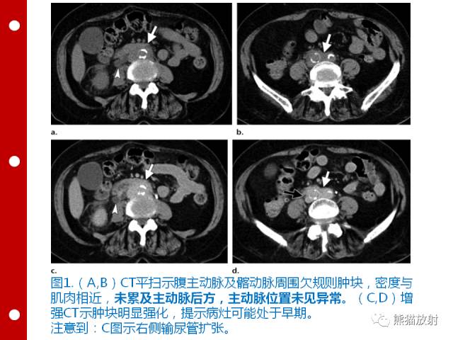 【病例】误诊为壁间血肿的腹膜后纤维化1例CT/PET影像表现