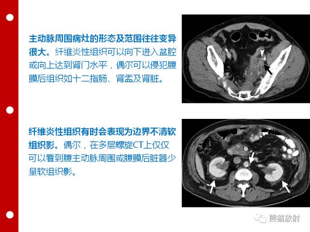【病例】误诊为壁间血肿的腹膜后纤维化1例CT/PET影像表现