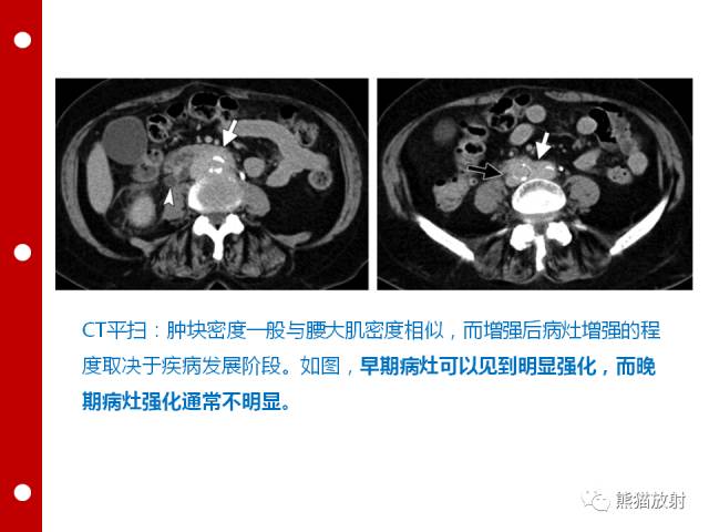 【病例】误诊为壁间血肿的腹膜后纤维化1例CT/PET影像表现