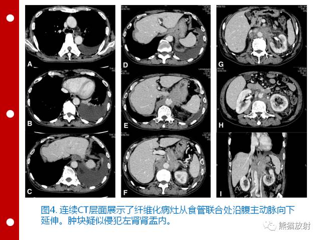 【病例】误诊为壁间血肿的腹膜后纤维化1例CT/PET影像表现