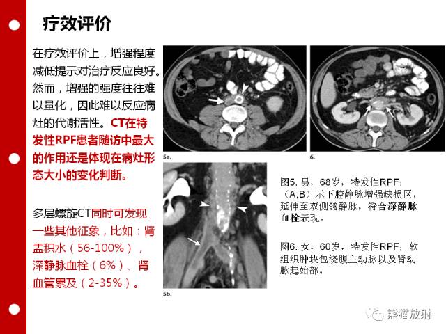 【病例】误诊为壁间血肿的腹膜后纤维化1例CT/PET影像表现