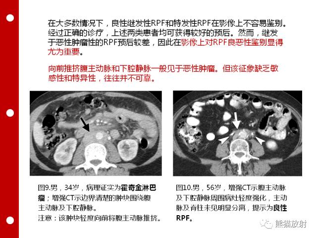 【病例】误诊为壁间血肿的腹膜后纤维化1例CT/PET影像表现