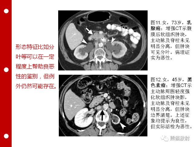 【病例】误诊为壁间血肿的腹膜后纤维化1例CT/PET影像表现