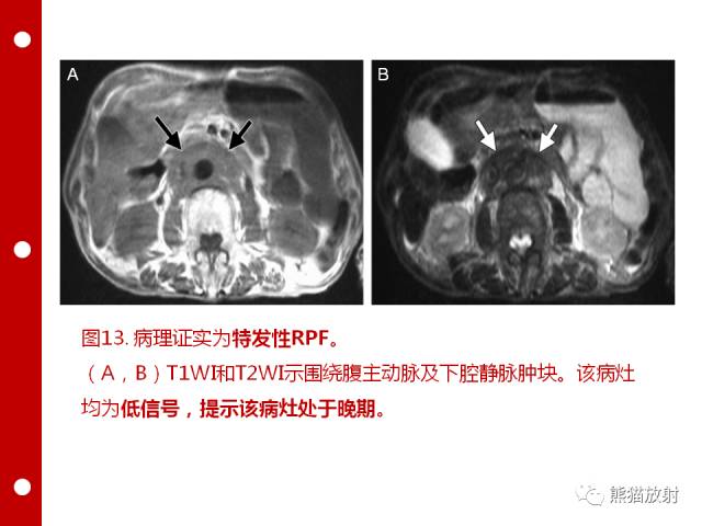 【病例】误诊为壁间血肿的腹膜后纤维化1例CT/PET影像表现
