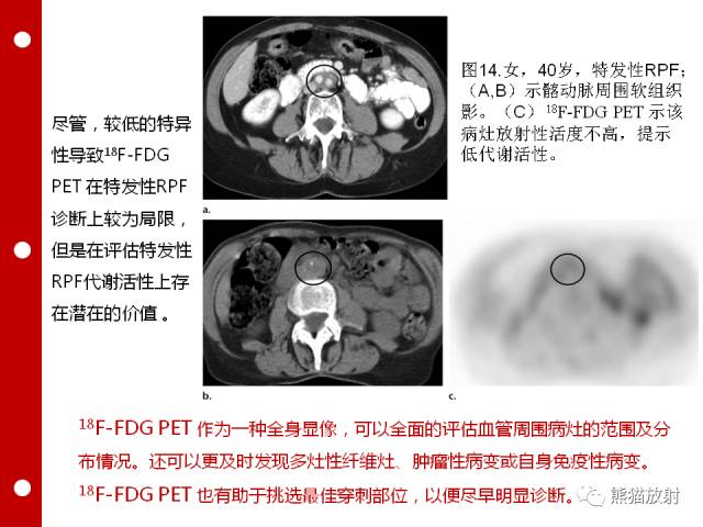 【病例】误诊为壁间血肿的腹膜后纤维化1例CT/PET影像表现