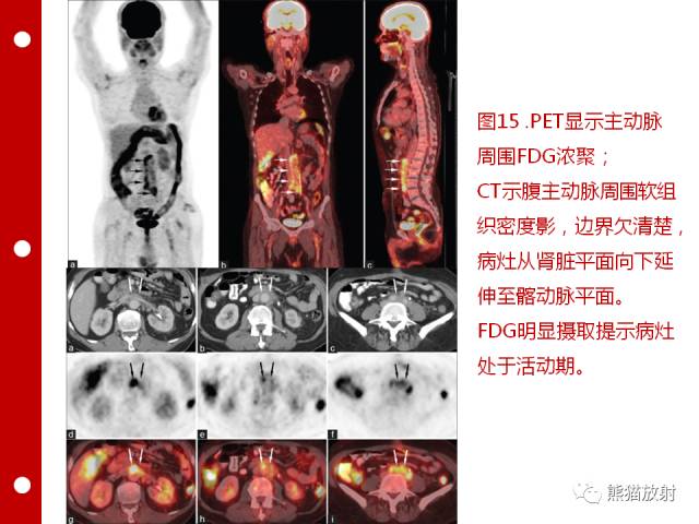 【病例】误诊为壁间血肿的腹膜后纤维化1例CT/PET影像表现