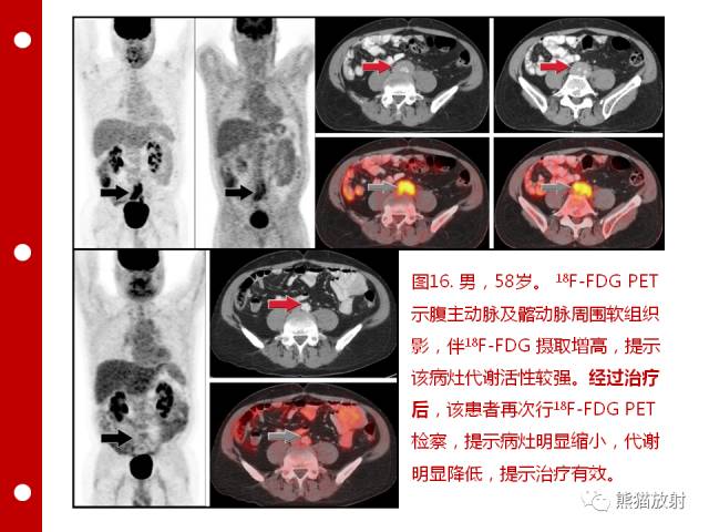 【病例】误诊为壁间血肿的腹膜后纤维化1例CT/PET影像表现