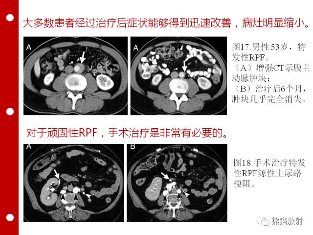 【病例】误诊为壁间血肿的腹膜后纤维化1例CT/PET影像表现