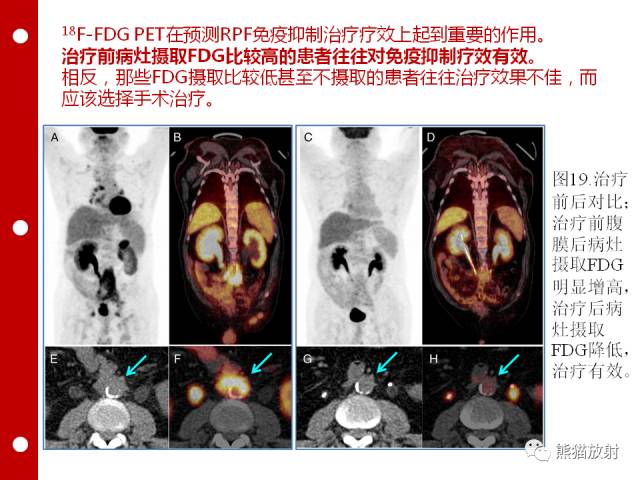 【病例】误诊为壁间血肿的腹膜后纤维化1例CT/PET影像表现