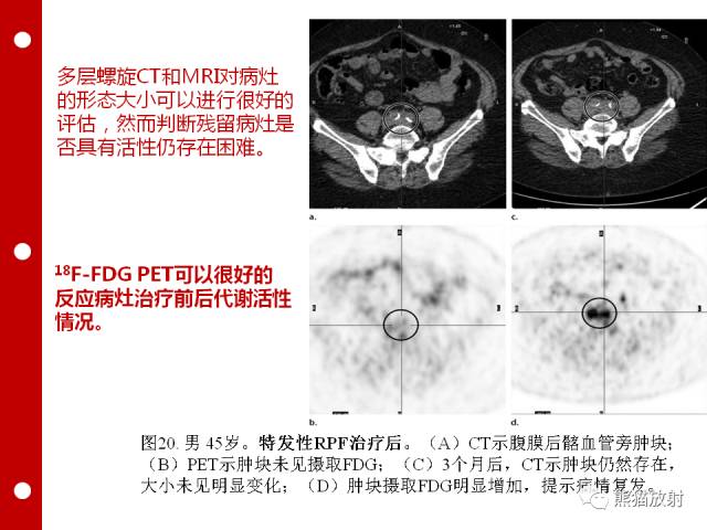 【病例】误诊为壁间血肿的腹膜后纤维化1例CT/PET影像表现