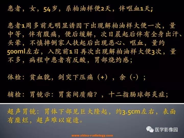 【病例】胃神经鞘瘤1例CT影像表现