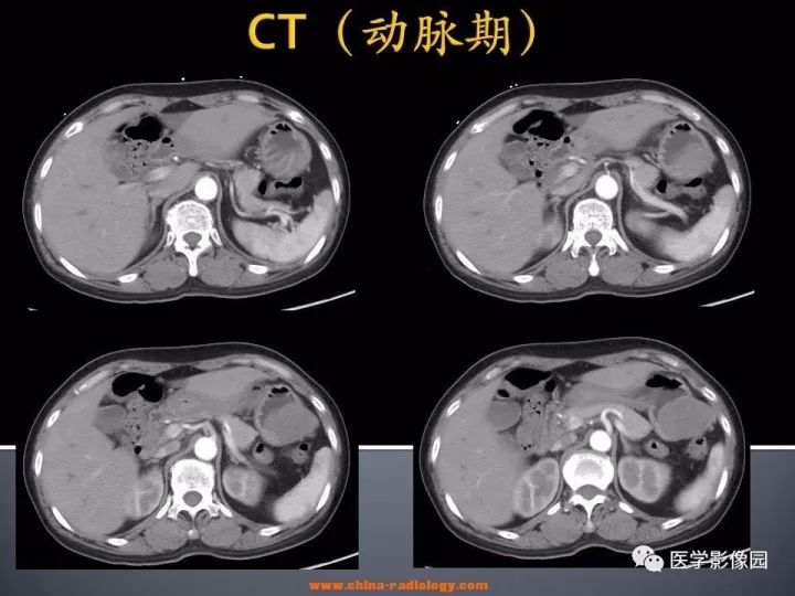 【病例】胃神经鞘瘤1例CT影像表现