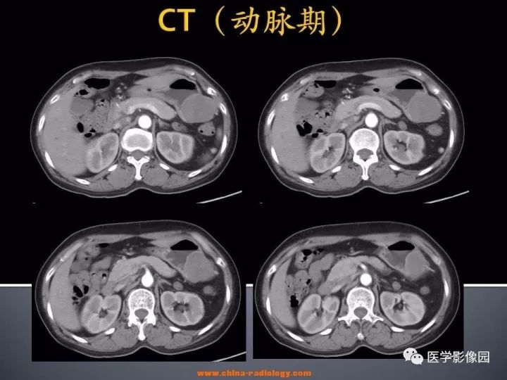 【病例】胃神经鞘瘤1例CT影像表现