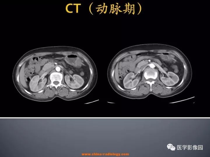 【病例】胃神经鞘瘤1例CT影像表现