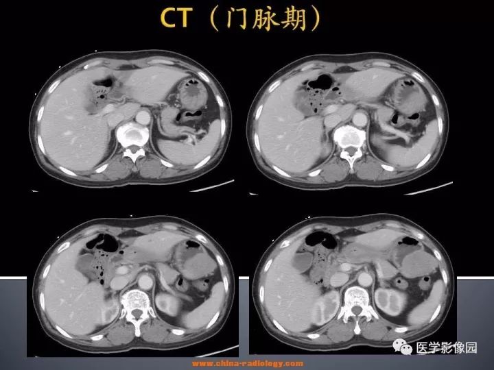 【病例】胃神经鞘瘤1例CT影像表现