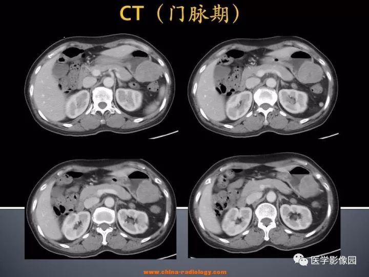 【病例】胃神经鞘瘤1例CT影像表现