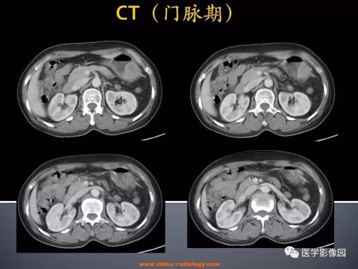 【病例】胃神经鞘瘤1例CT影像表现