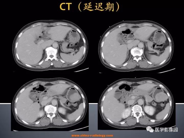 【病例】胃神经鞘瘤1例CT影像表现