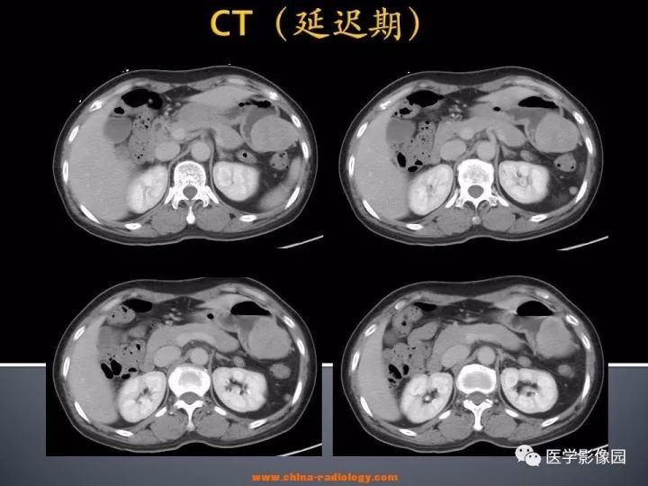 【病例】胃神经鞘瘤1例CT影像表现