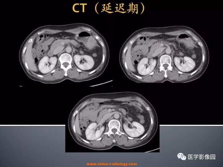 【病例】胃神经鞘瘤1例CT影像表现