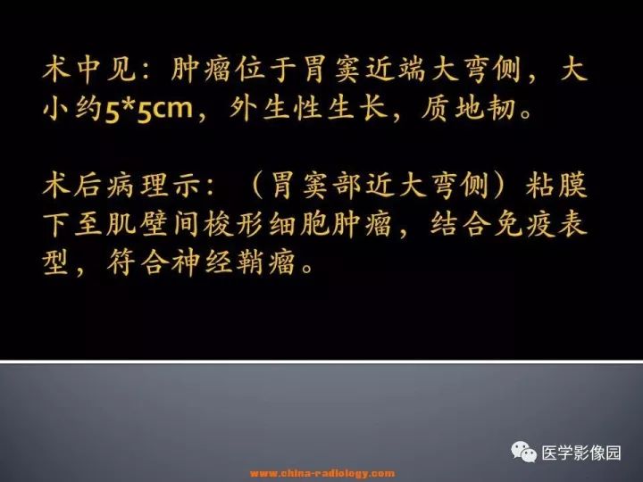 【病例】胃神经鞘瘤1例CT影像表现