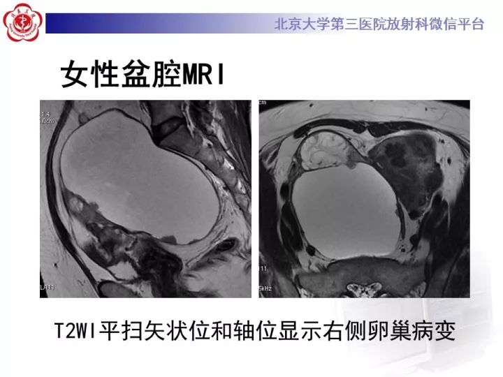 【病例】子宫内膜异位相关性卵巢癌1例MR