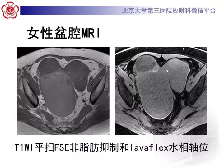 【病例】子宫内膜异位相关性卵巢癌1例MR
