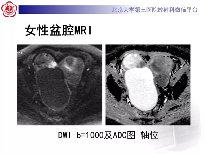 【病例】子宫内膜异位相关性卵巢癌1例MR