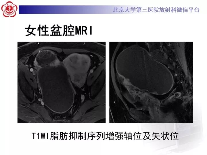 【病例】子宫内膜异位相关性卵巢癌1例MR