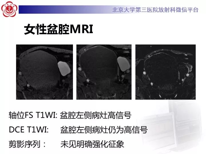 【病例】子宫内膜异位相关性卵巢癌1例MR
