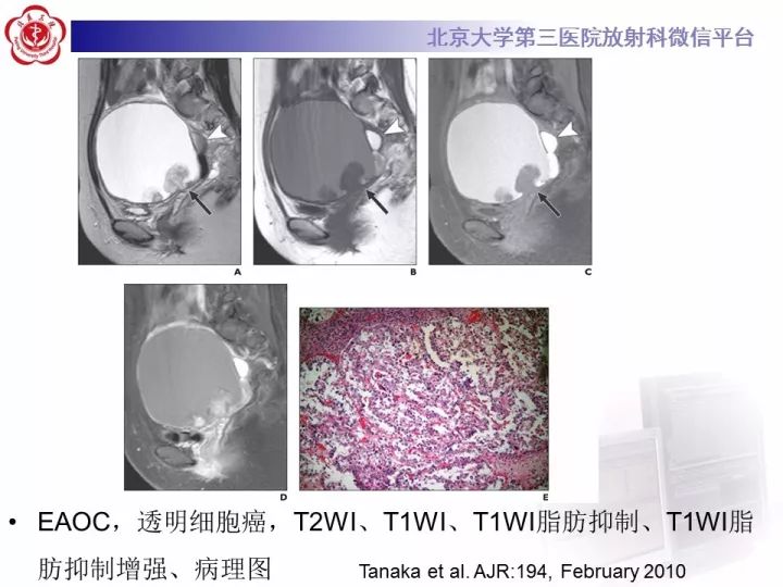 【病例】子宫内膜异位相关性卵巢癌1例MR