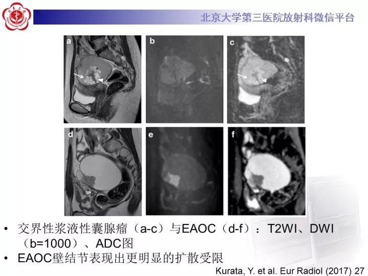 【病例】子宫内膜异位相关性卵巢癌1例MR