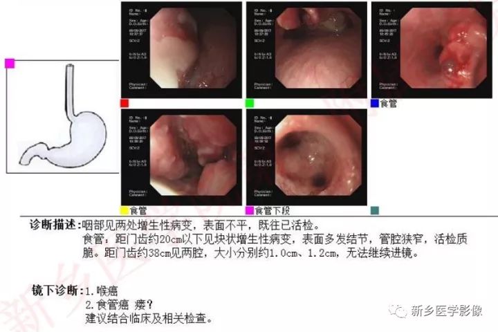【病例】喉癌1例CT影像表现 【病例】喉癌1例CT影像表现