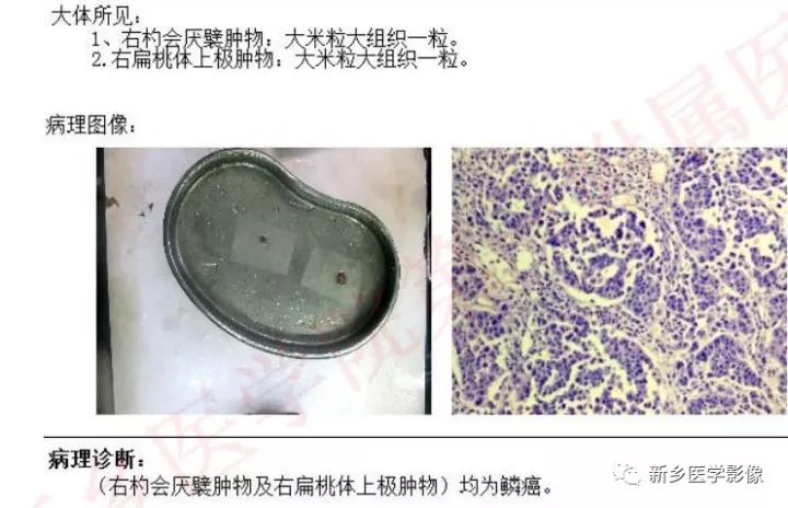 【病例】喉癌1例CT影像表现 【病例】喉癌1例CT影像表现