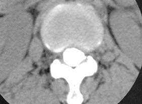 【病例】椎管内转移性腺癌1例CT影像表现 【病例】椎管内转移性腺癌1例CT影像表现