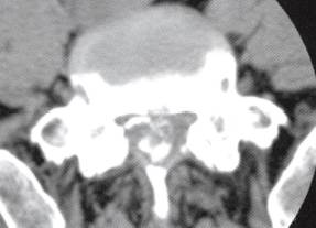 【病例】椎管内转移性腺癌1例CT影像表现 【病例】椎管内转移性腺癌1例CT影像表现