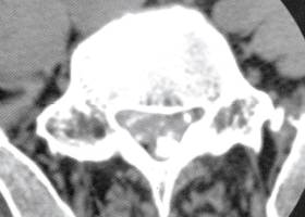 【病例】椎管内转移性腺癌1例CT影像表现 【病例】椎管内转移性腺癌1例CT影像表现
