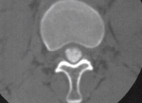 【病例】椎管内转移性腺癌1例CT影像表现