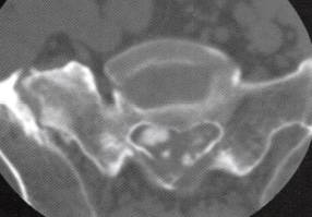 【病例】椎管内转移性腺癌1例CT影像表现 【病例】椎管内转移性腺癌1例CT影像表现