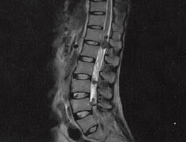 【病例】椎管内转移性腺癌1例CT影像表现 【病例】椎管内转移性腺癌1例CT影像表现