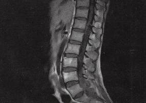 【病例】椎管内转移性腺癌1例CT影像表现 【病例】椎管内转移性腺癌1例CT影像表现