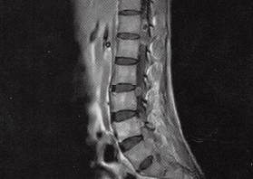 【病例】椎管内转移性腺癌1例CT影像表现 【病例】椎管内转移性腺癌1例CT影像表现