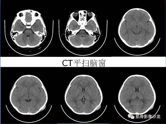 【病例】罗道病RDD一例CT及MR影像表现 【病例】罗道病RDD一例CT及MR影像表现