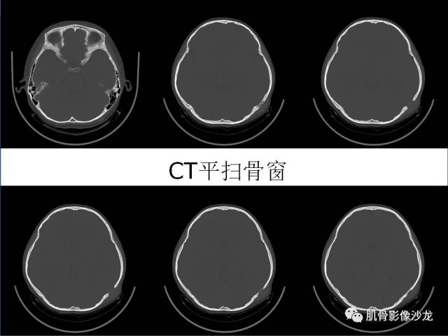 【病例】罗道病RDD一例CT及MR影像表现 【病例】罗道病RDD一例CT及MR影像表现