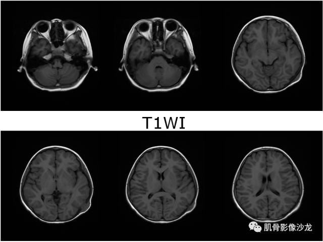 【病例】罗道病RDD一例CT及MR影像表现 【病例】罗道病RDD一例CT及MR影像表现